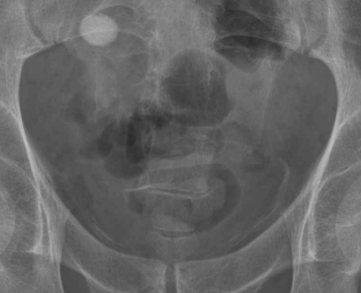 Sán máng bàng quang (Schistosomiasis urinary tract manifestations)