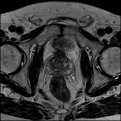 Ung thư biểu mô tế bào chuyển tiếp ở bàng quang (Transitional cell carcinoma (urinary bladder))