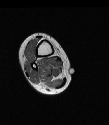  U vỏ bao thần kinh ngoại biên (Peripheral Nerve Sheath Tumors)