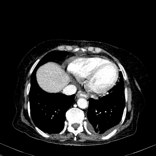 Rò mỏm tá tràng sau mổ (Duodenal stump leak)