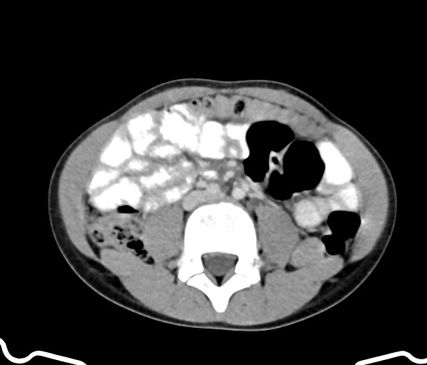 Viêm u hạt mạn tính (Malakoplakia)