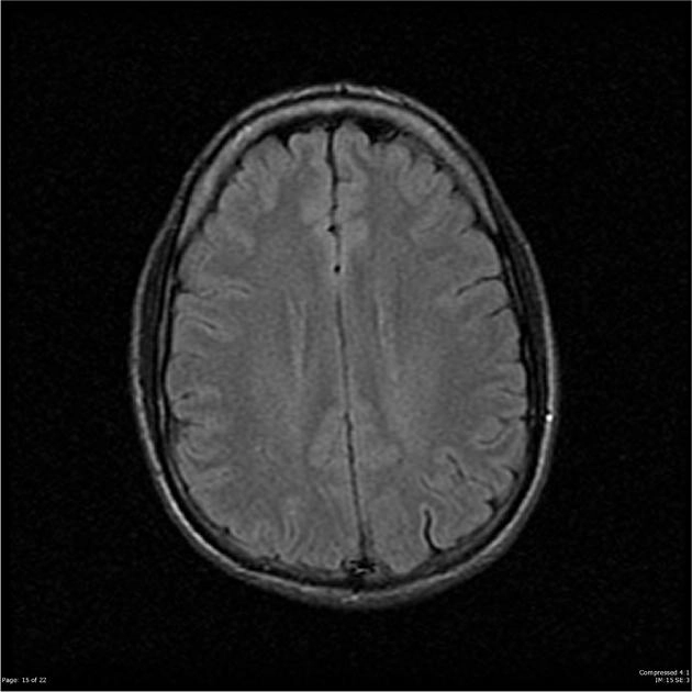 Nhồi máu não bán cấp (Subacute Cerebral Infarction)