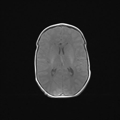 Thoát vị tủy màng tủy (Myelomeningocele)