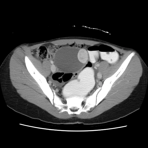 Khối u mô đệm xơ hóa (Sclerosing Stromal Tumor - SST)