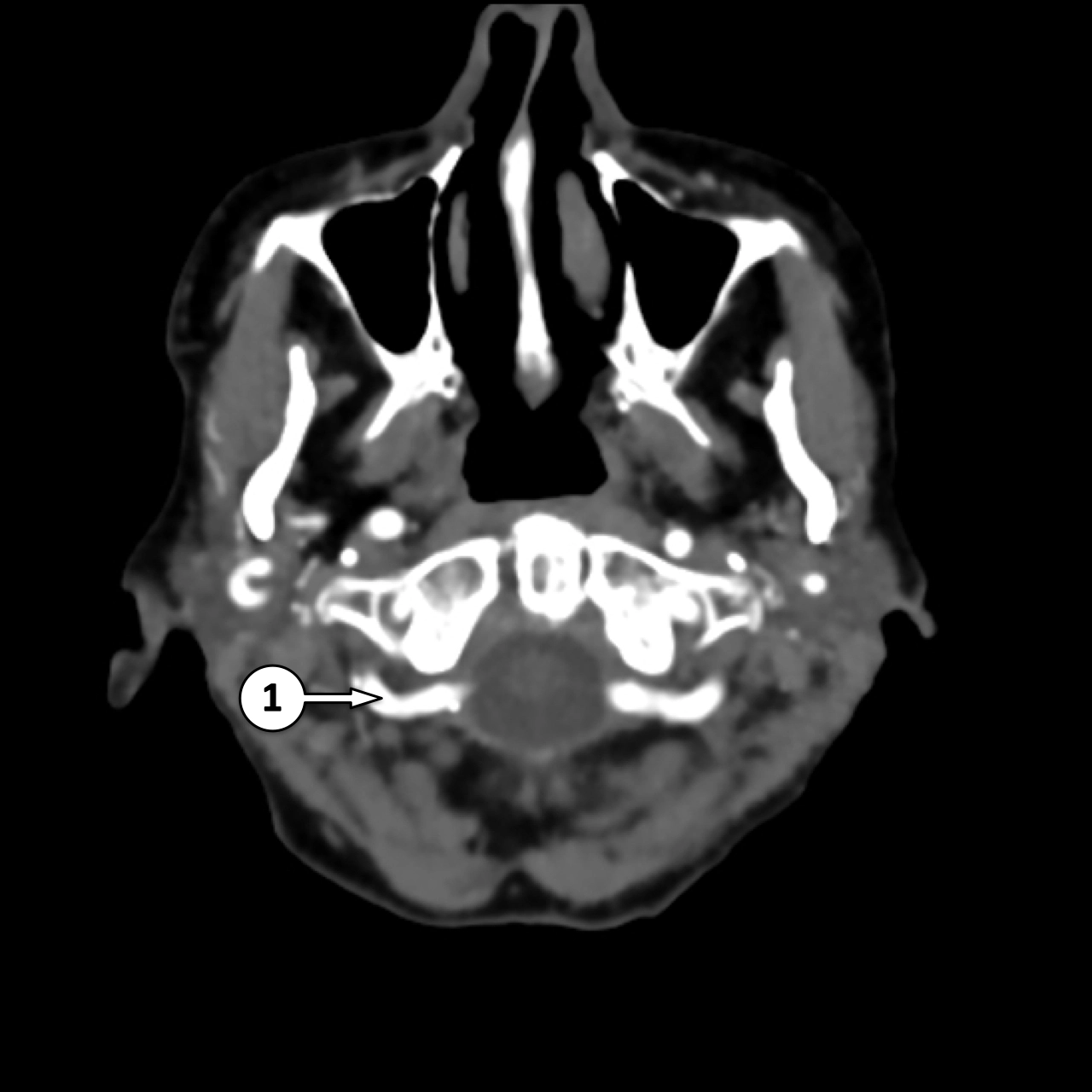 CTA mạch máu não