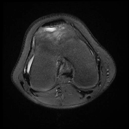  Viêm bao hoạt dịch dưới bánh chè sâu (Deep infrapatellar bursitis)