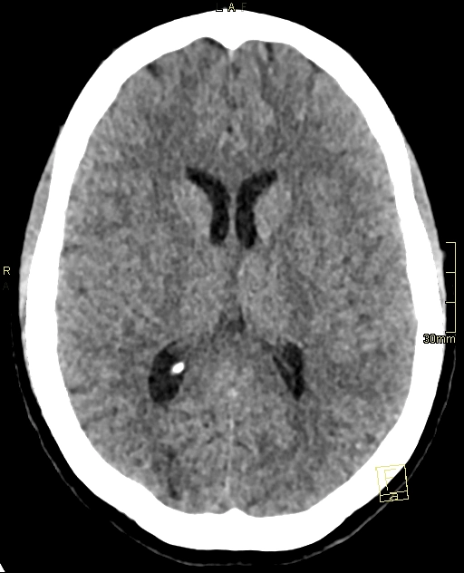  Đột quỵ thiếu máu cục bộ động mạch ở trẻ em (Childhood Arterial Ischemic Stroke)