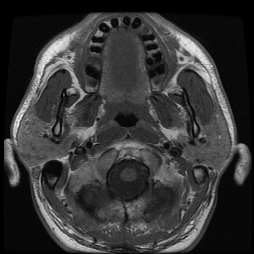 Tổn thương lympho tuyến mang tai lành tính (Benign Lymphoepithelial Lesion - BLL)