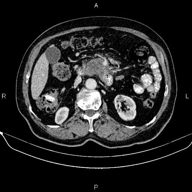 Ung thư biểu mô tuyến ống tụy (Pancreatic Ductal Adenocarcinoma - PDAC)