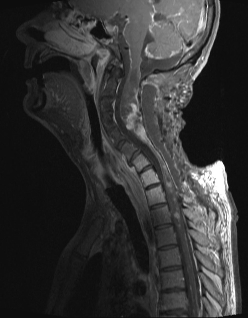 U di căn trong màng cứng-ngoài tủy (Intradural extramedullary metastases)
