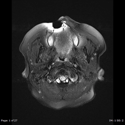 Di căn nền sọ (Skull Base Metastasis)