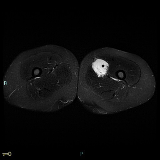 U cơ trơn mạch máu (Angioleiomyoma)