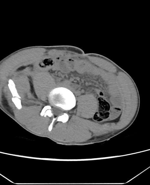 Thủng ruột non (Small bowel perforation)