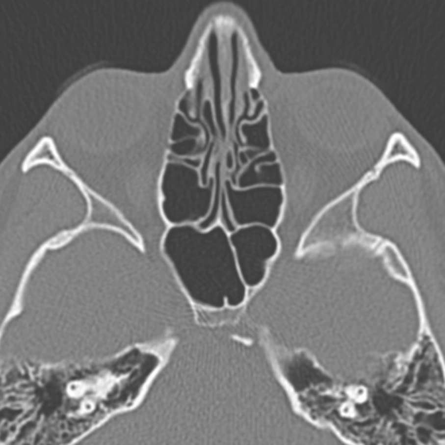 Tổn thương mỡ lành tính xương bướm (Ngưng khí hóa xương bướm- Arrested pneumatization of the sphenoid sinus)