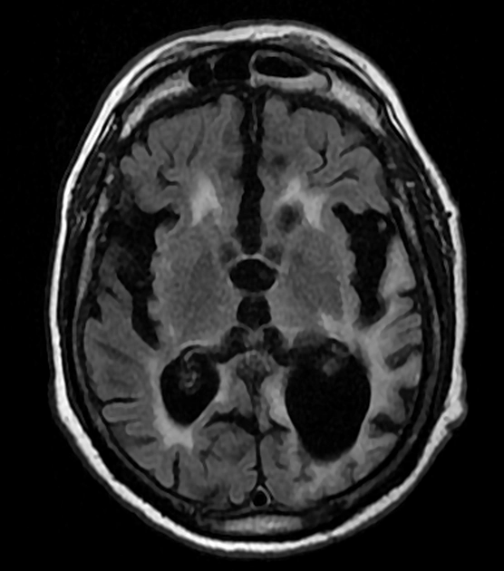 Nhiễm sắt bề mặt vỏ não (Cortical Superficial Siderosis- cSS)