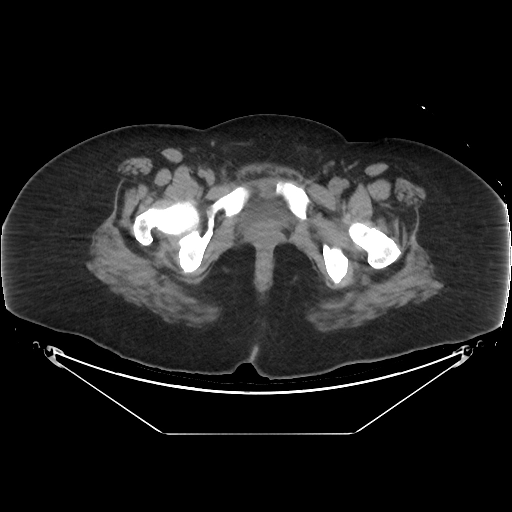 Viêm nội mạc tử cung (Endometritis)