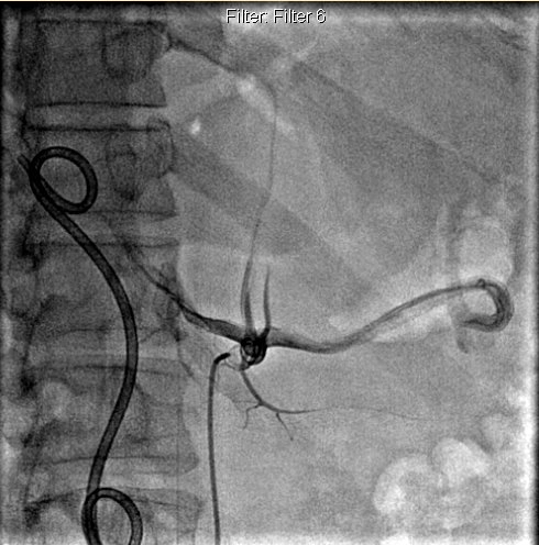 Xuất huyết tiêu hóa trên (Upper gastrointestinal bleeding - UGIB)