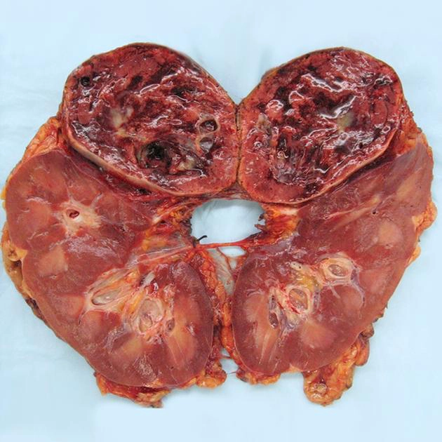 U tủy thượng thận (Pheochromocytoma)