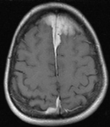 Viêm màng não phì đại liên quan đến IgG4 (IgG4-related hypertrophic pachymeningitis)