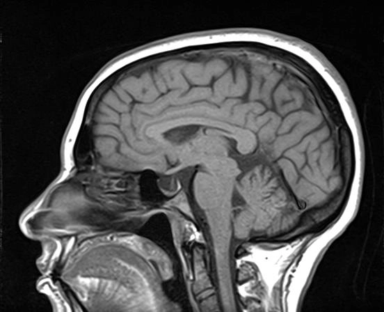 Schwannoma dây thần kinh hàm dưới (Masticator Space CNV3 Schwannoma)