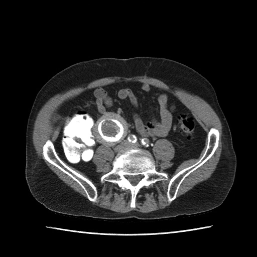 Ung thư biểu mô tế bào chuyển tiếp niệu quản (Transitional cell carcinoma of ureter- TCC)