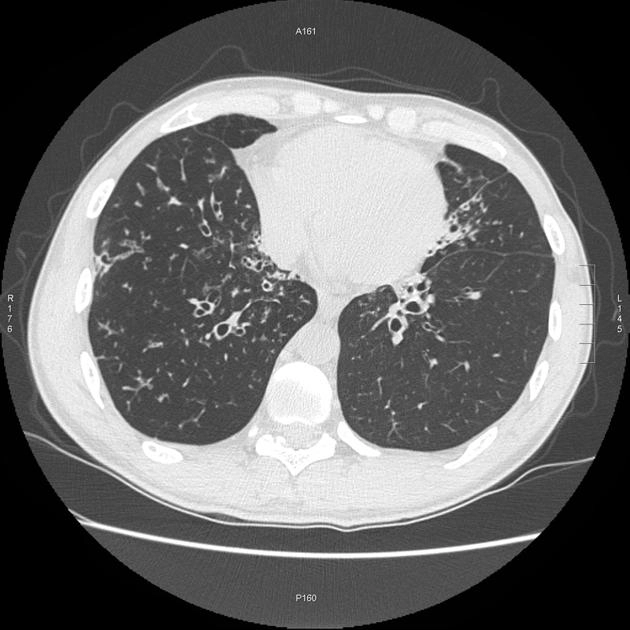 Viêm phổi do Mycobacterium không điển hình (Pulmonary non-tuberculous mycobacterial infection - NTM)/ Mycobacterium không phải lao
