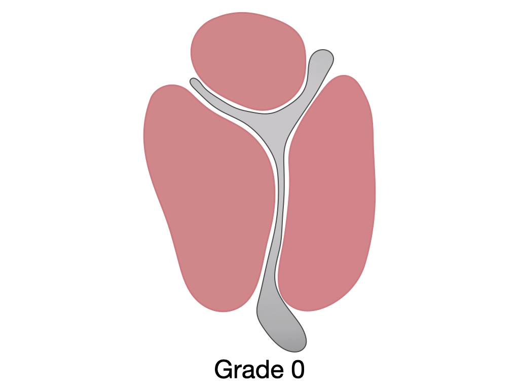 Thoái hóa mỡ cơ khớp vai (Goutallier classification of rotator cuff muscle fatty degeneration)