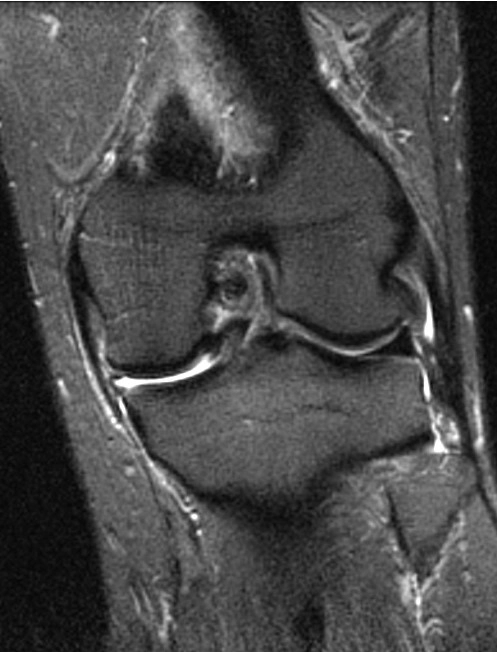 Bộ ba bất hạnh của O'Donoghue (O'Donoghue unhappy triad)