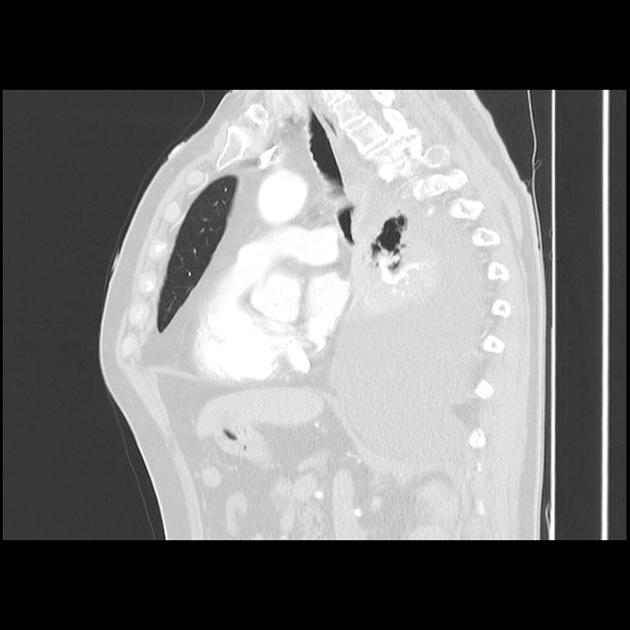 Tràn dịch màng phổi ác tính (Malignant Pleural Effusion - MPE)