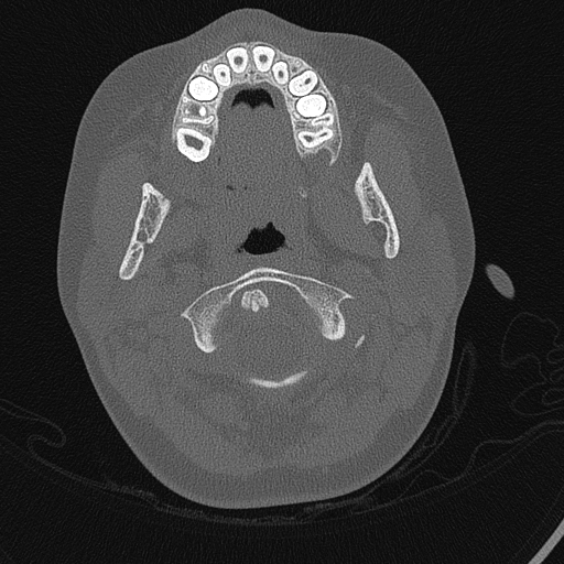 Tịt ống tai ngoài (External auditory canal atresia)