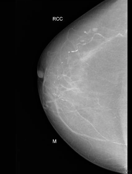 Vôi hóa mạch máu ở vú (Vascular calcification in breast)
