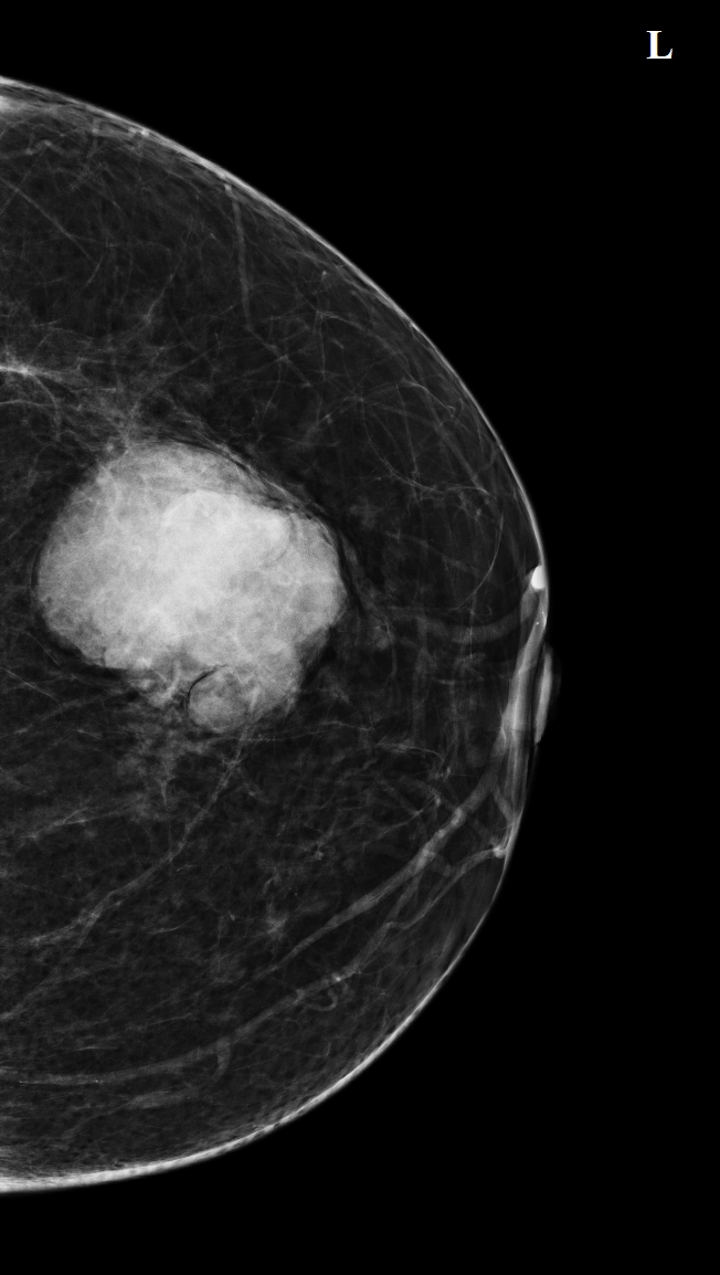 U diệp thể ác tính của vú (Malignant phyllodes tumor)