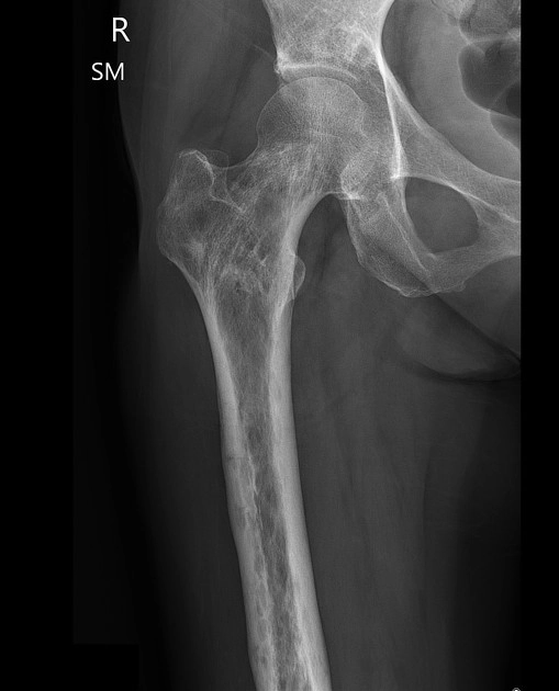 Sarcoma xương thứ phát (Secondary osteosarcoma)