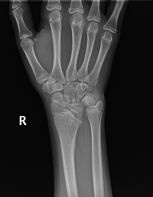 Biến dạng cổ tay Madelung (Madelung deformity)