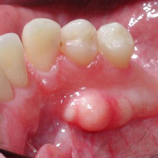Lồi xương hàm dưới (Mandibular torus)