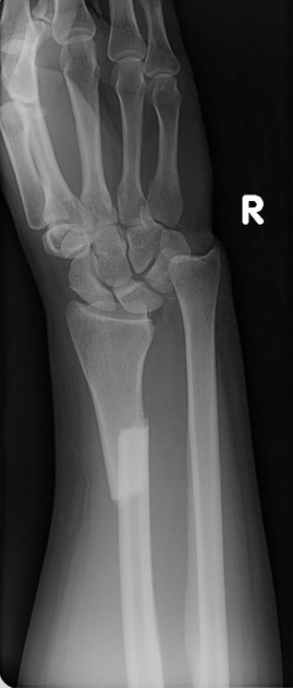 Gãy Galeazzi (Galeazzi fracture-dislocation)
