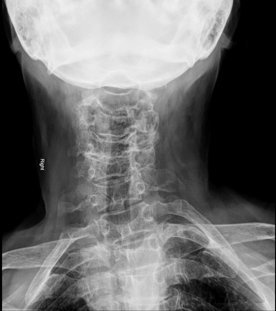 Thoái hóa cột sống (Spondylosis)