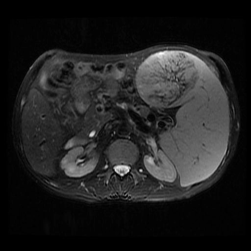Tạo máu ngoài tủy tại lách (Extramedullary hematopoiesis in the spleen)