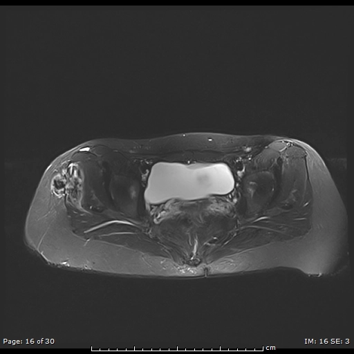 U sợi dạng desmoid/ U sợi xâm lấn tại chỗ (Desmoid-Type Fibromatosis/Aggressive fibromatosis)