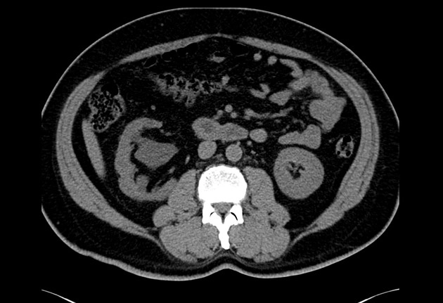 Bệnh tích tụ mỡ xoang thận (Renal sinus lipomatosis)