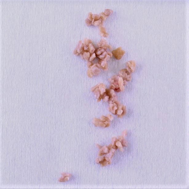 Sỏi bàng quang (Bladder calculus)