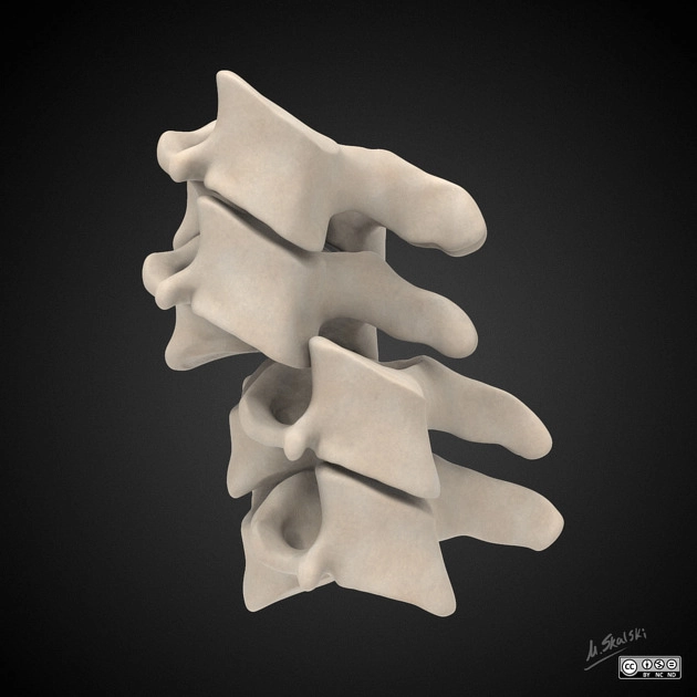 Trật khớp liên mấu (Facet dislocation)