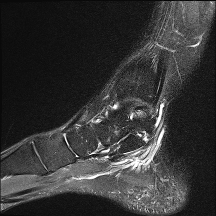 Hội chứng đệm mỡ gót chân (Heel fat pad syndrome)