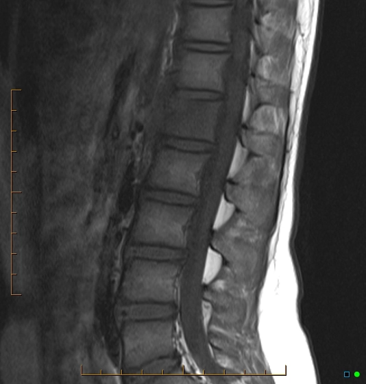 Thoát vị đĩa đệm trong thân đốt sống (nốt Schmorl)