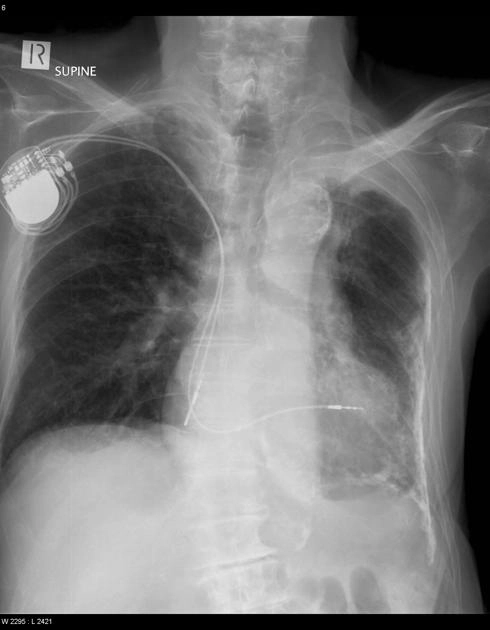 Xơ hóa màng phổi và Dày dính màng phổi (Pleural Fibrosis and Fibrothorax)
