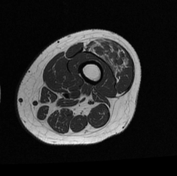 U máu (Hemagioma) mô mềm (Soft tissue hemangioma)