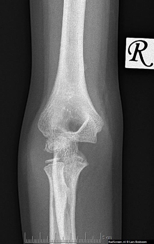 Hoại tử vô mạch chỏm con xương cánh tay (Osteonecrosis of the capitellum)