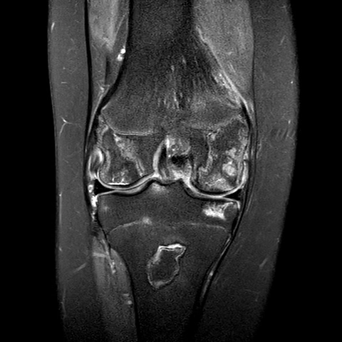 Hoại tử vô mạch ở gối (Osteonecrosis of the Knee)
