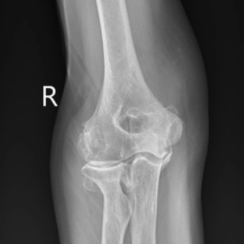 Thoái hóa khớp khuỷu (Elbow Osteoarthritis)
