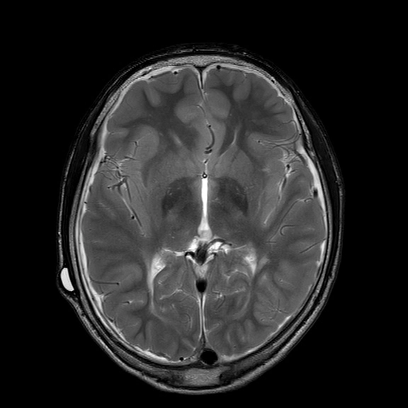 Dẫn lưu CSF quá mức (CSF overdrainage)